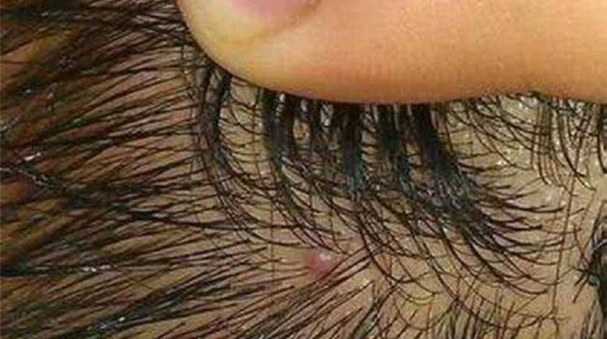 头皮长痘痘什么原因,头皮里面长痘痘是什么原因呢