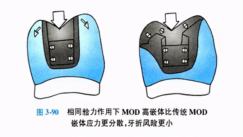 牙科嵌体的处理,牙科医生讲义