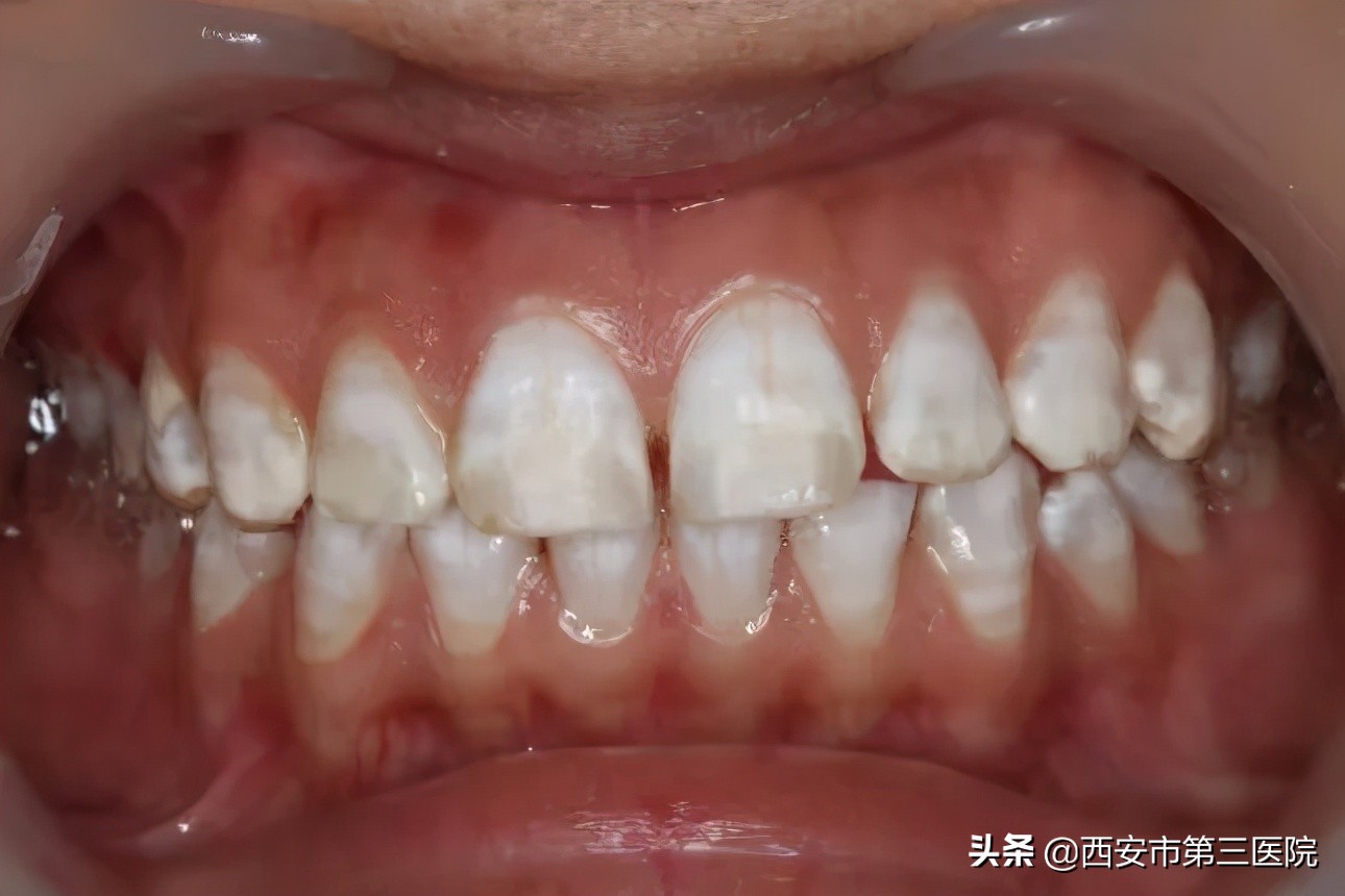 常见牙齿美白方式大盘点,牙齿美白性价比最高的方法
