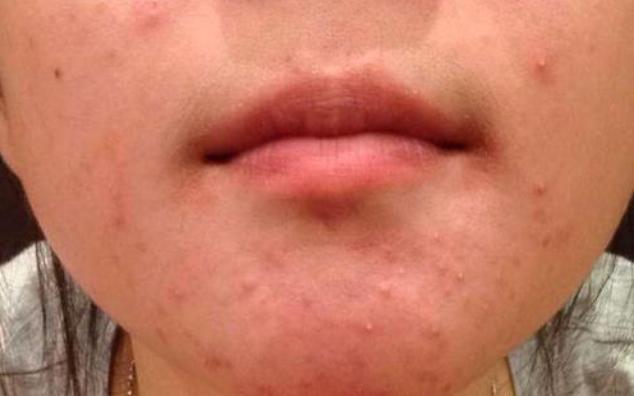 脸上长痘是身体原因还是皮肤原因,脸上长痘可能是什么病引起的