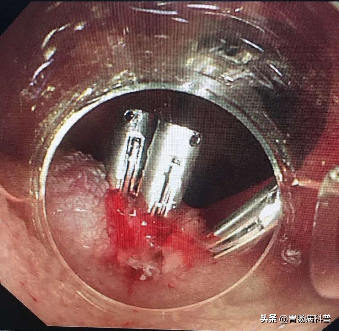 儿童拉血直肠息肉怎么治,3岁的孩子直肠息肉排便带血