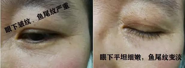 雅诗兰黛日本产的眼霜,用了雅诗兰黛皱纹更明显了