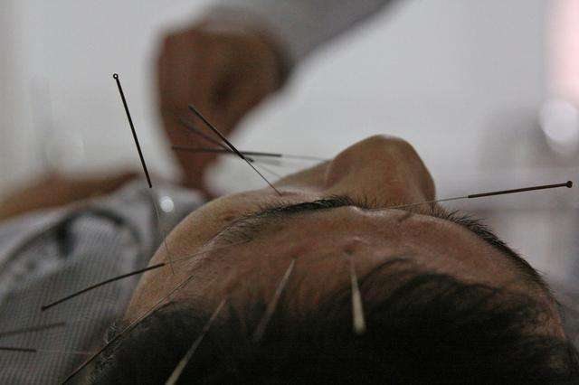 刺血疗法视频,透穴刺法大全