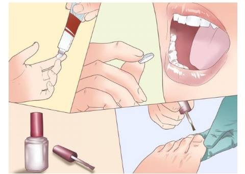 灰指甲是不是治疗不了,灰指甲是不是自己不好治