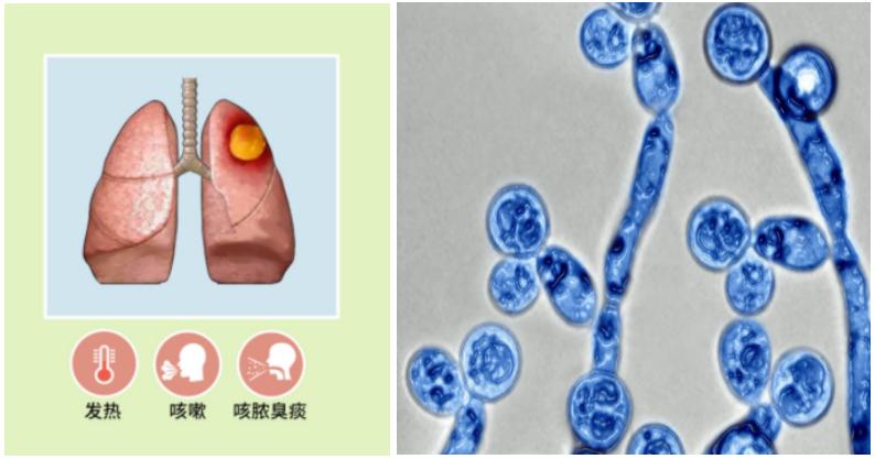 医护奋战27小时救回羊水栓塞产妇,广西驰援武汉护士抢救26天