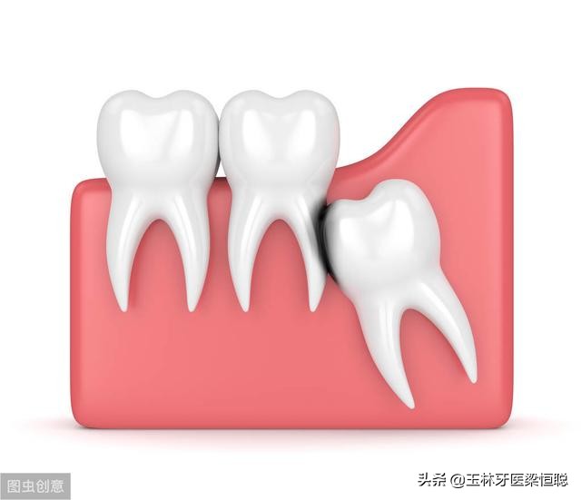 中医认为智齿需要拔除吗,正位智齿需要拔除吗