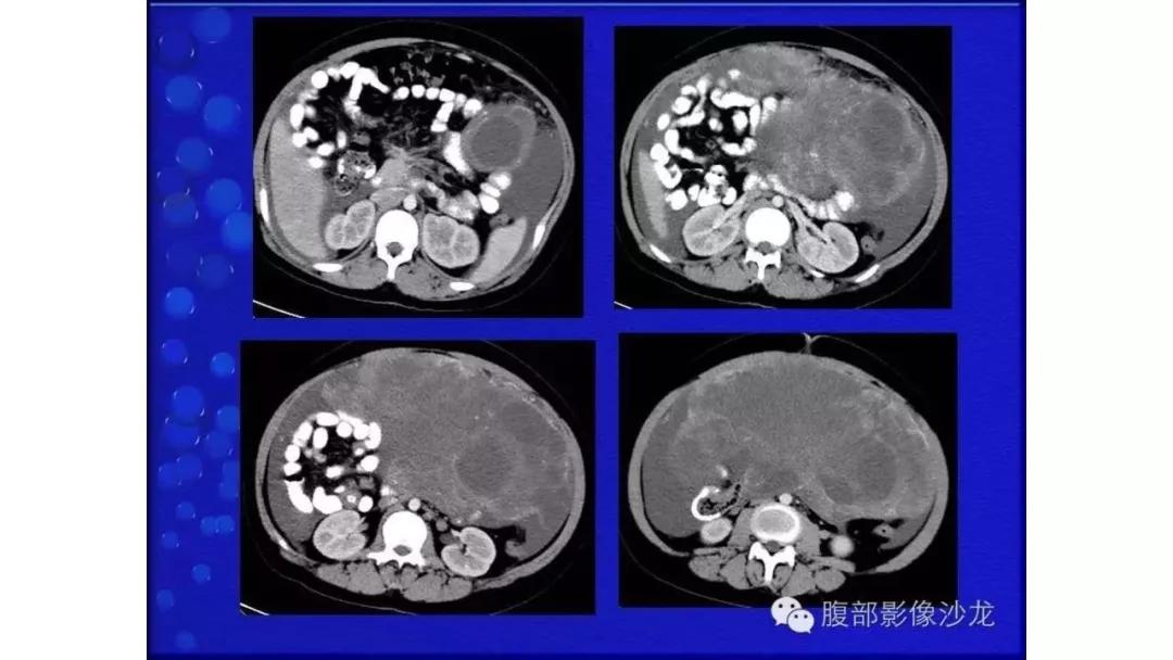 卵巢原发肿瘤的分析思路