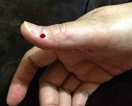 经穴之可治小儿高热，咽喉肿痛的少商穴