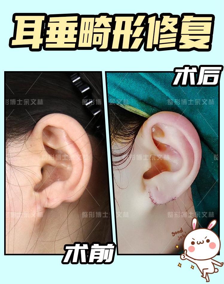耳垂裂开修复哪里可以做,耳垂裂到哪个科室去修复