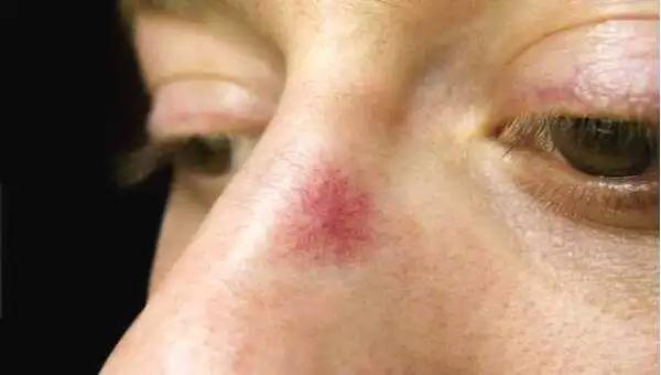 身上突然长咖啡色肉痣是咋回事,身上出现红色痣一定与肝脏有关吗