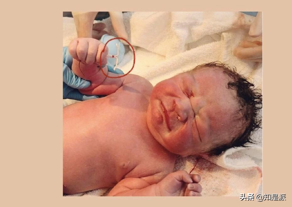 男婴手握节育环出生后续,手握避孕环的胎儿