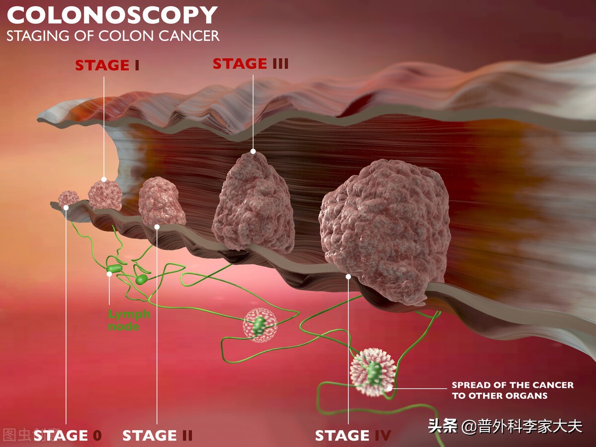 结肠癌三期还能治愈吗,结肠癌三期化疗方法