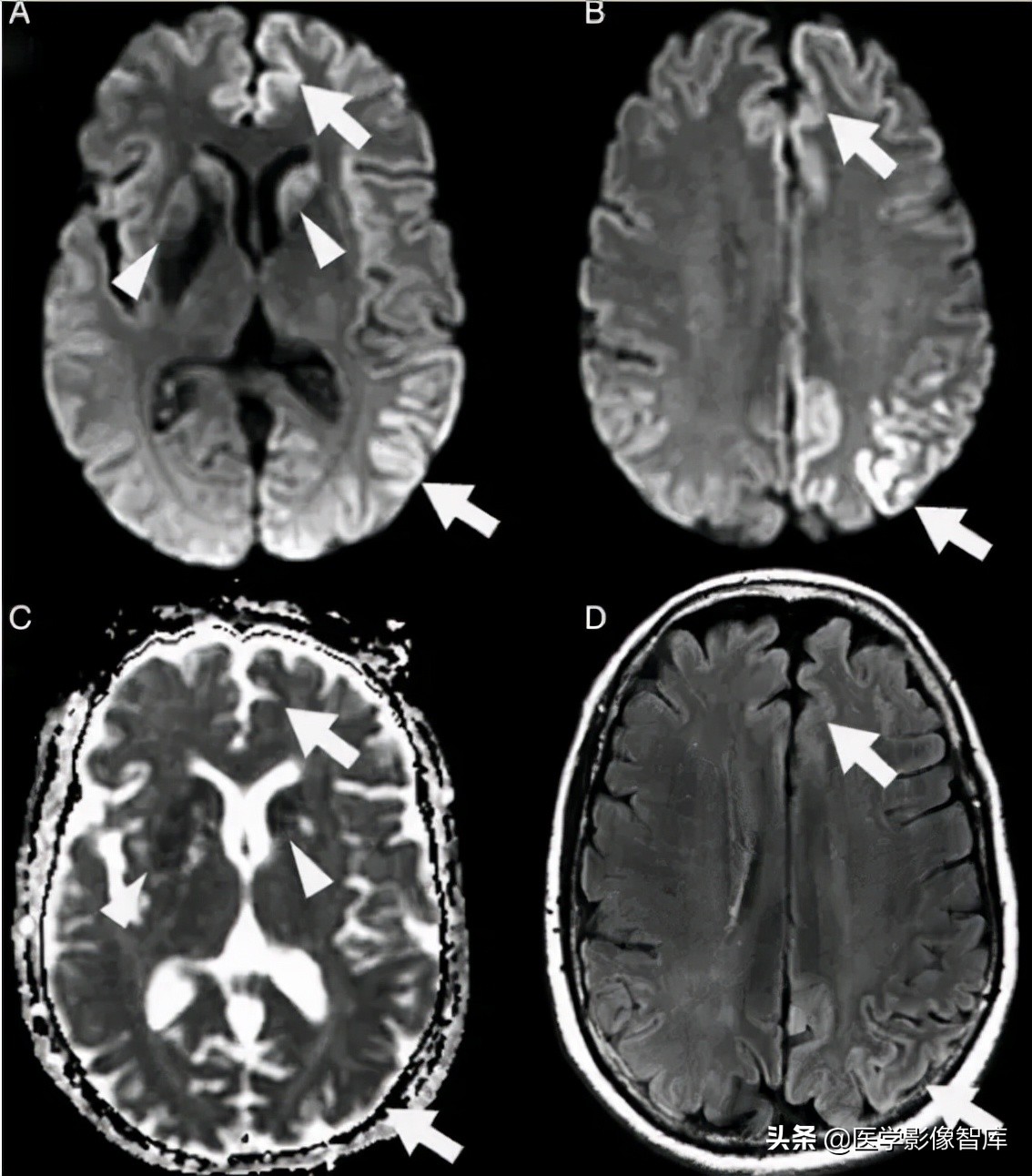 双侧额叶皮层区dwi偏高是什么意思,颅内dwi高信号病变