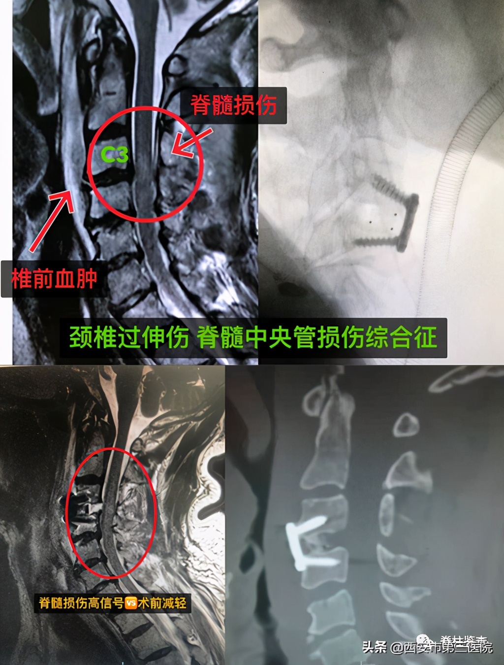 颈椎病减压手术安全么,手术脊髓减压