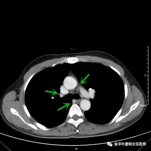 伴有脑转移了的肺癌能手术吗？
