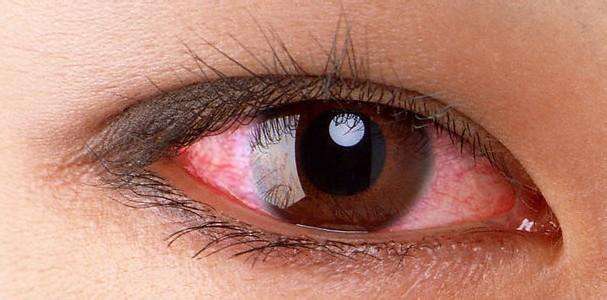 15岁戴隐形眼镜对眼睛有什么危害,戴了20年的隐形眼镜有什么危害