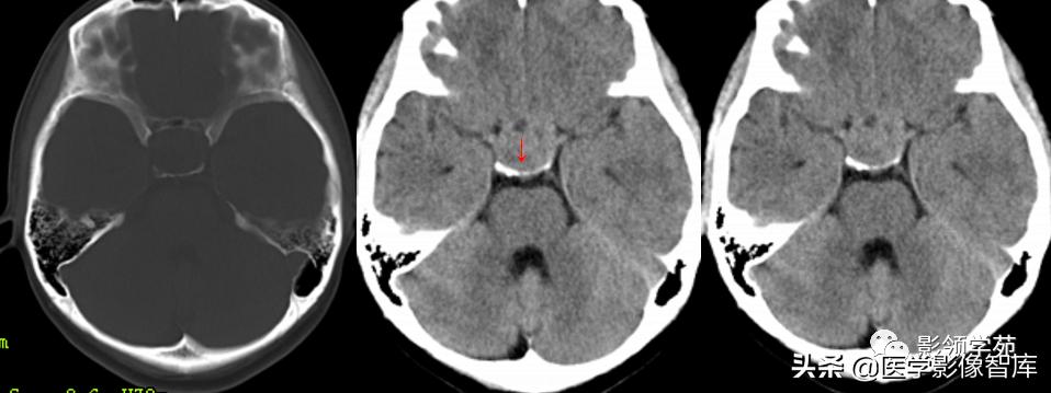 鞍区肿瘤做什么检查得出来,鞍区肿瘤的影像学鉴别