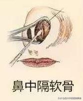 鼻中隔软骨隆鼻有什么优点,鼻中隔软骨隆鼻手术永久的吗