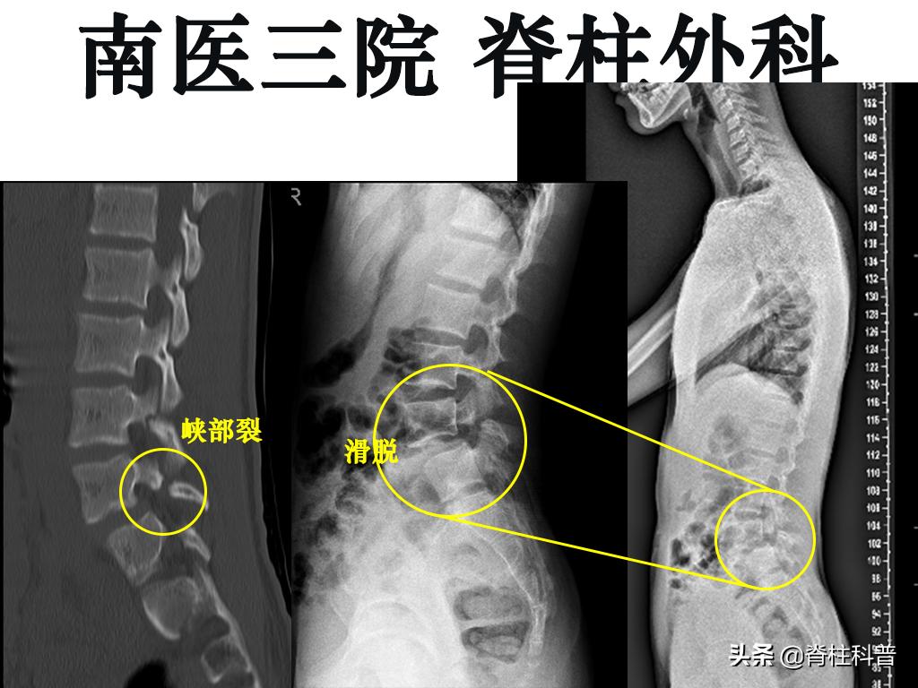 腰痛引起腰椎滑脱怎么治,十七岁腰椎痛怎么办