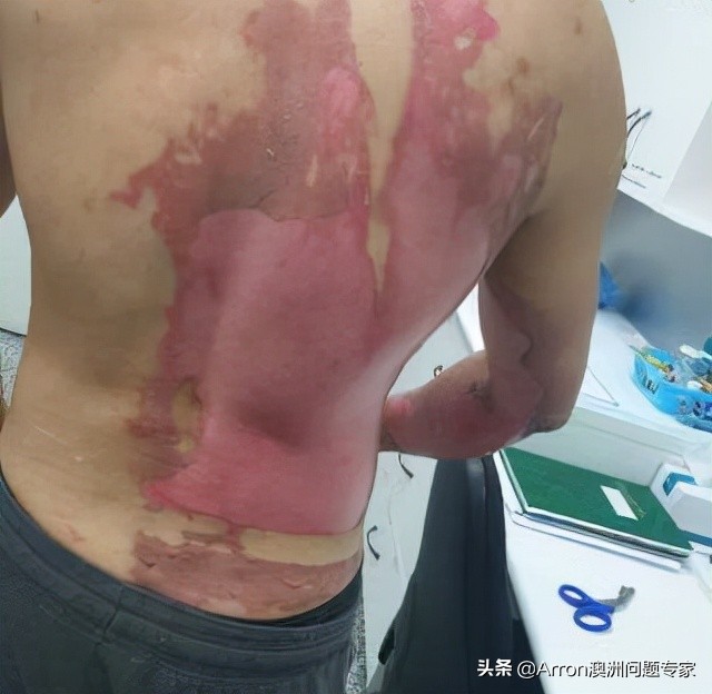 澳大利亚剔骨工到底有多累,澳大利亚剔骨工现状