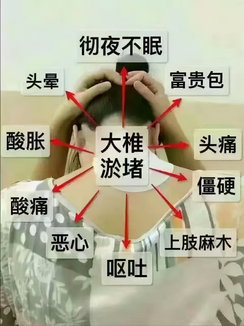 背部长了烦人的“富贵包”?4则医案告诉你,中医随证加减治疗