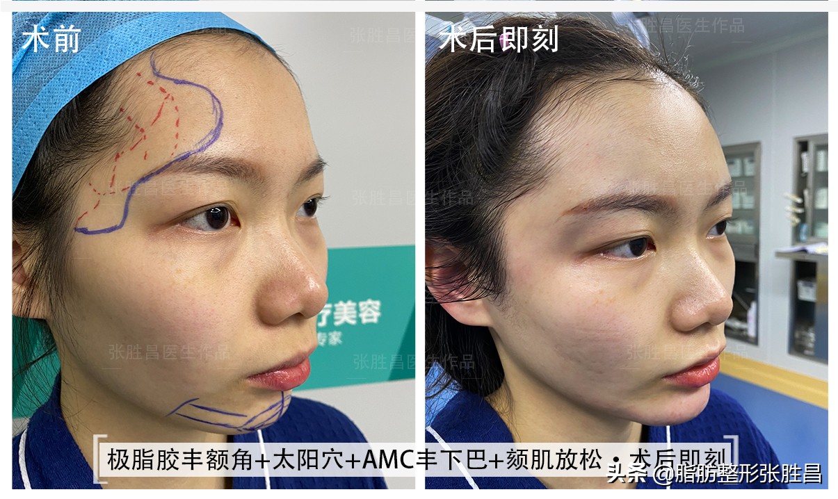 下巴后缩但不想脸变长,下巴后缩不想正颌只想整齐