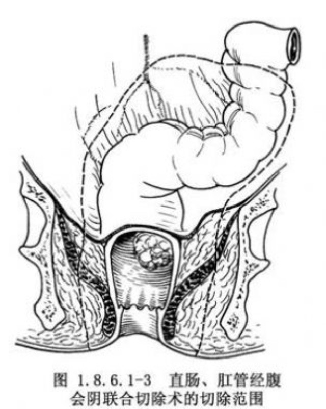 “难以启齿”的肛门癌，你了解他吗？出现这3个症状，或许不妙