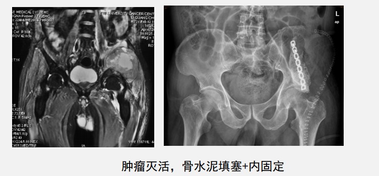 深入骨髓的痛！30年前不能治的骨转移，现在或有3个机会