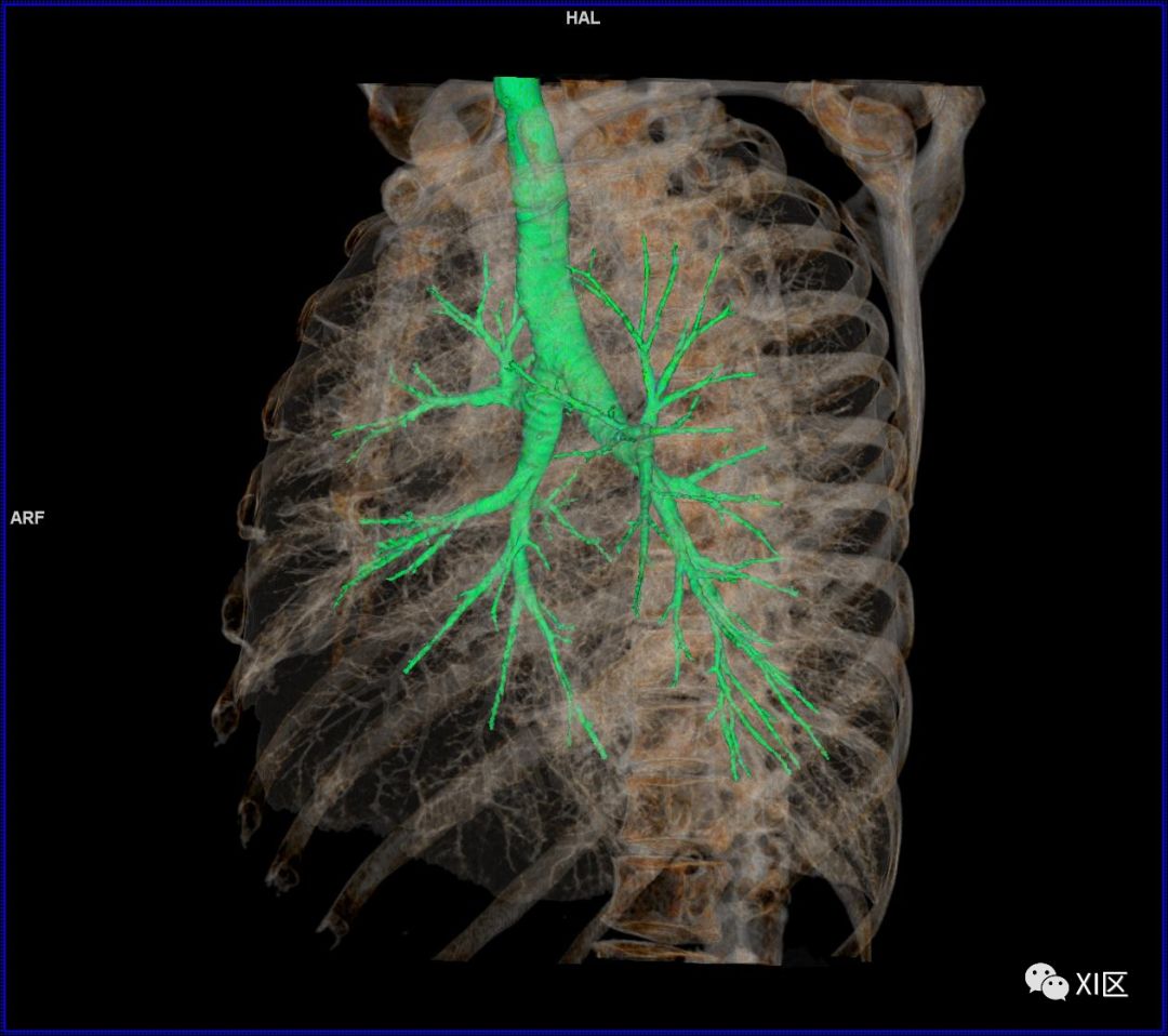 如此详细的肺部影像解剖，有点儿酷