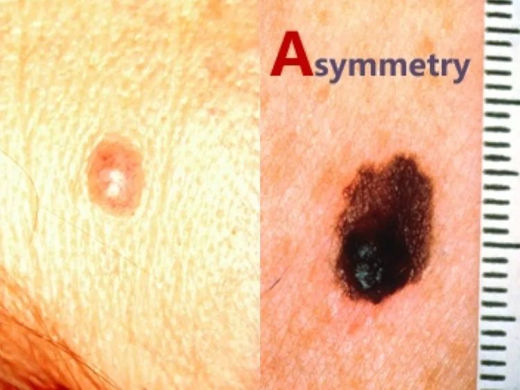 激光点痣不小心照了紫灯怎么办,切除黑色素痣可能癌变吗