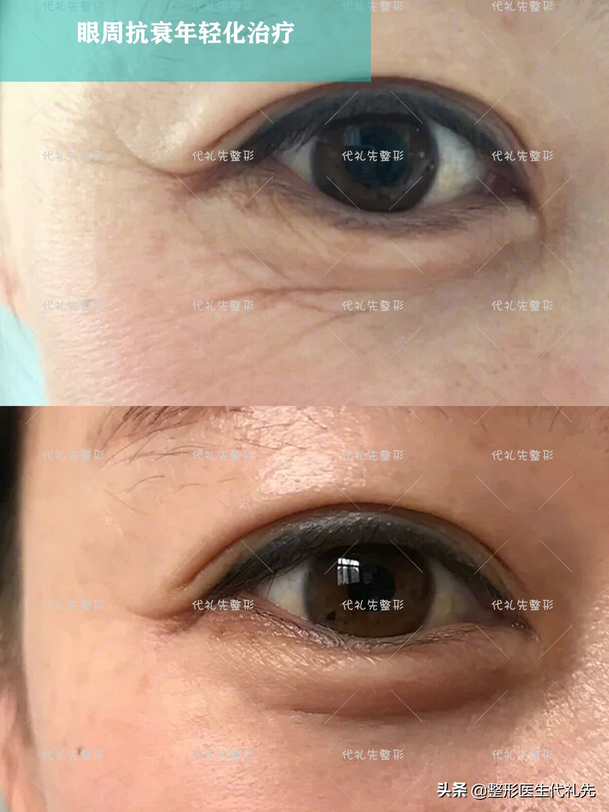 眼纹干纹是什么原因,眼部衰老导致眼纹