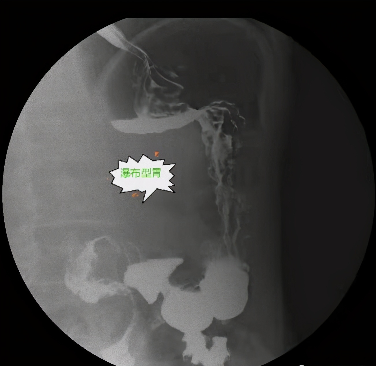 ​武汉一男子弯腰就能缓解胃痛？原来他长了个瀑布胃