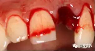 门牙撞了怎么办,门牙意外损坏怎么办