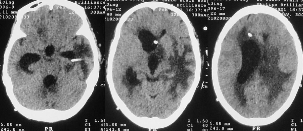 脑脓肿合并脑膜炎需要手术吗,脑脓肿进入左侧脑室严重吗