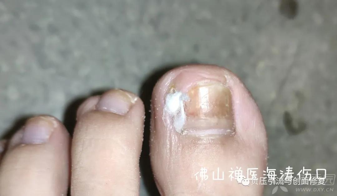 自己剪掉甲沟炎肉芽自己会消掉吗,甲沟炎拔甲后复发的几率多大