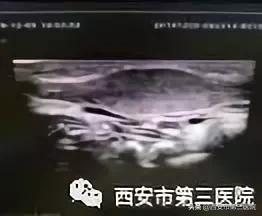 宝宝平常歪头容易导致斜颈吗,宝宝歪头症和斜颈可以治愈吗