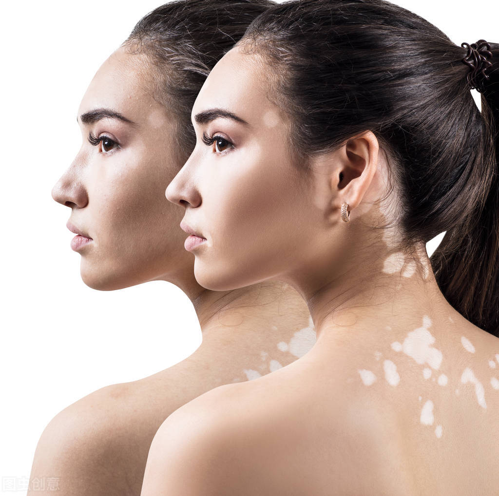 点阵激光治疗白癜风多久才有效,腰部有白癜风