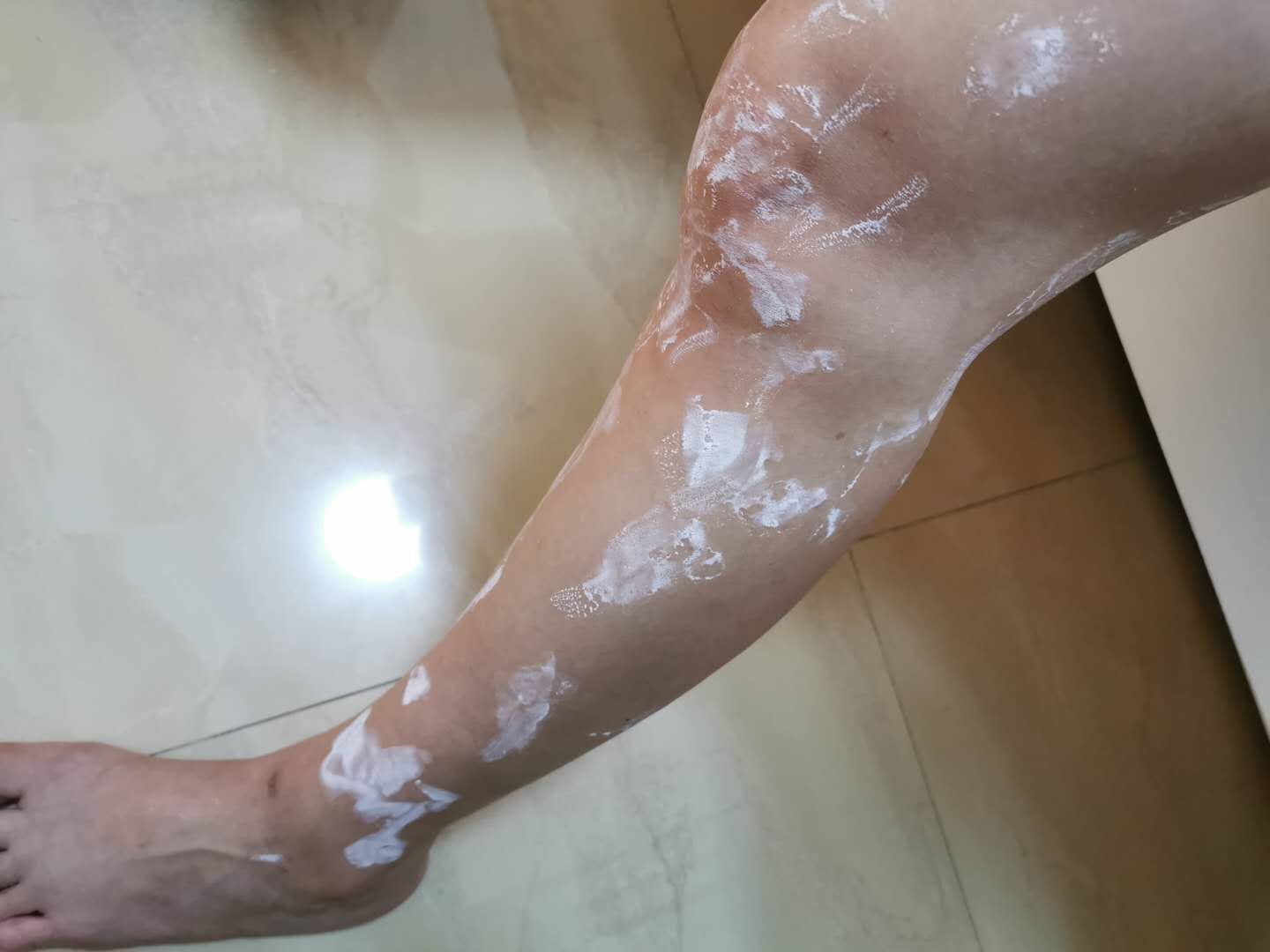 宝妈突然荨麻疹,孕晚期荨麻疹会不会早产