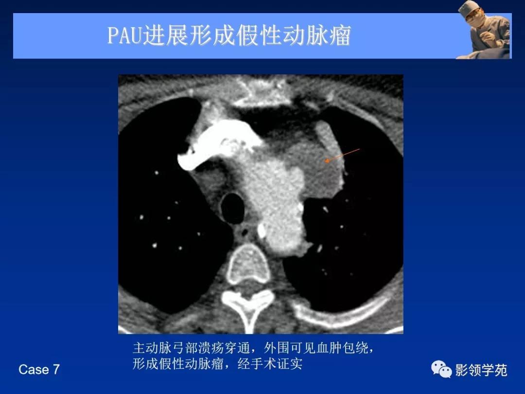 主动脉夹层壁间血肿如何鉴别,主动脉夹层血肿溃疡