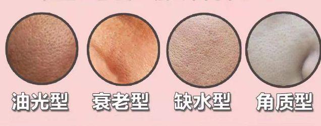 毛孔粗大黑头多怎么改善小技巧,毛孔粗大黑头多的原因和改善方法
