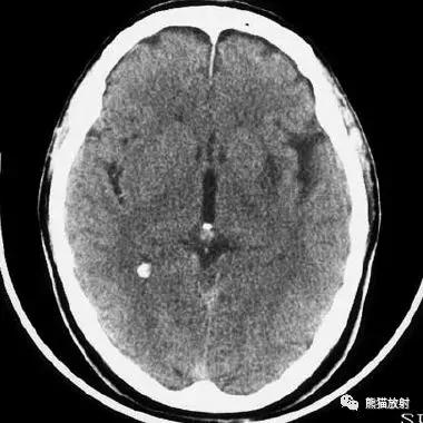 脑梗死丨演变、血供区域分布、CT表现