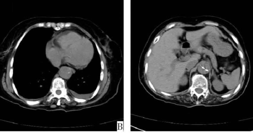 胸部Ct平扫能查出主动脉夹层吗,主动脉夹层cta影像图片解读