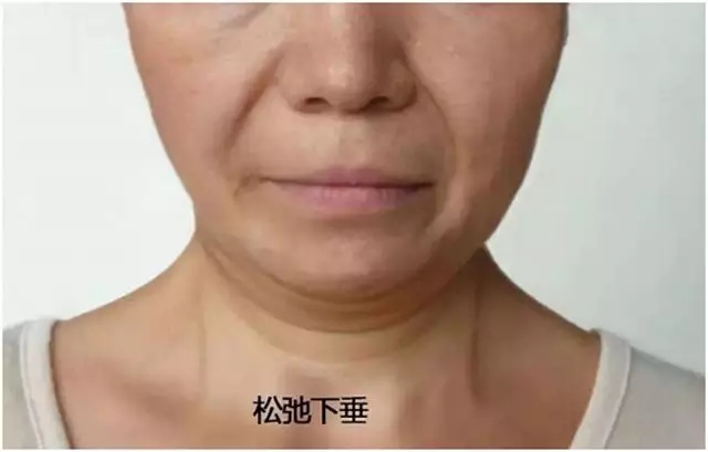 打瘦脸针后如何避免咬肌反弹,肉毒素瘦脸针怎么样避免碰到神经