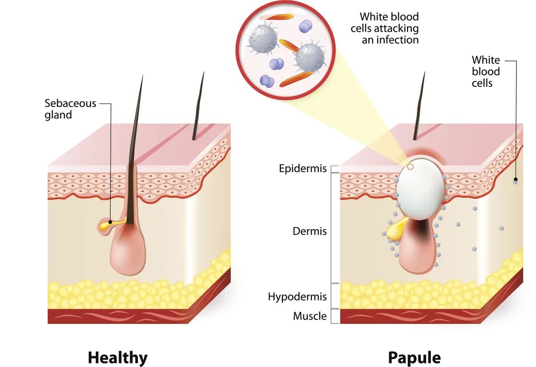 正确有效的祛除痘痘痘印方法,怎样才能彻底根治痘痘痘印