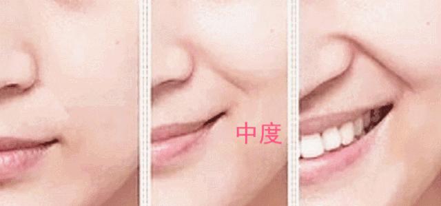 改善苹果肌法令纹紧致全脸动作,有法令纹了怎么改善是缺什么