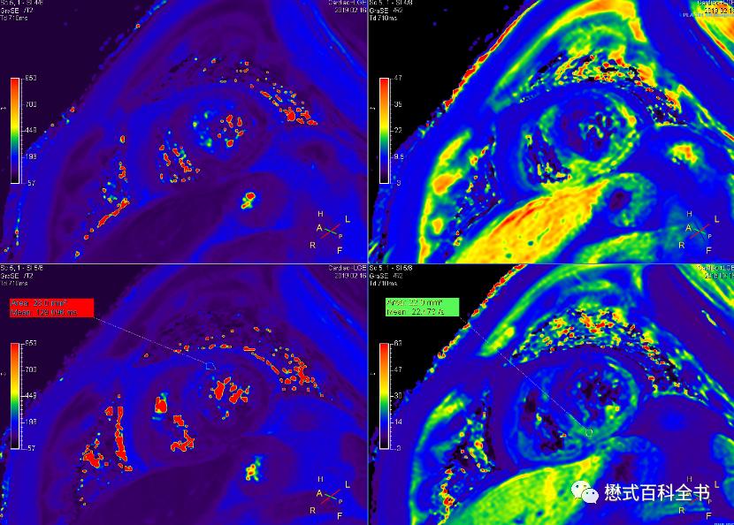 心脏磁共振定位方法,心脏磁共振各参数分析