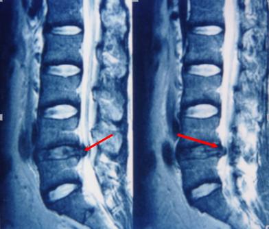 腰椎间盘突出针灸能治彻底吗,腰椎间盘突出针灸治疗能彻底吗