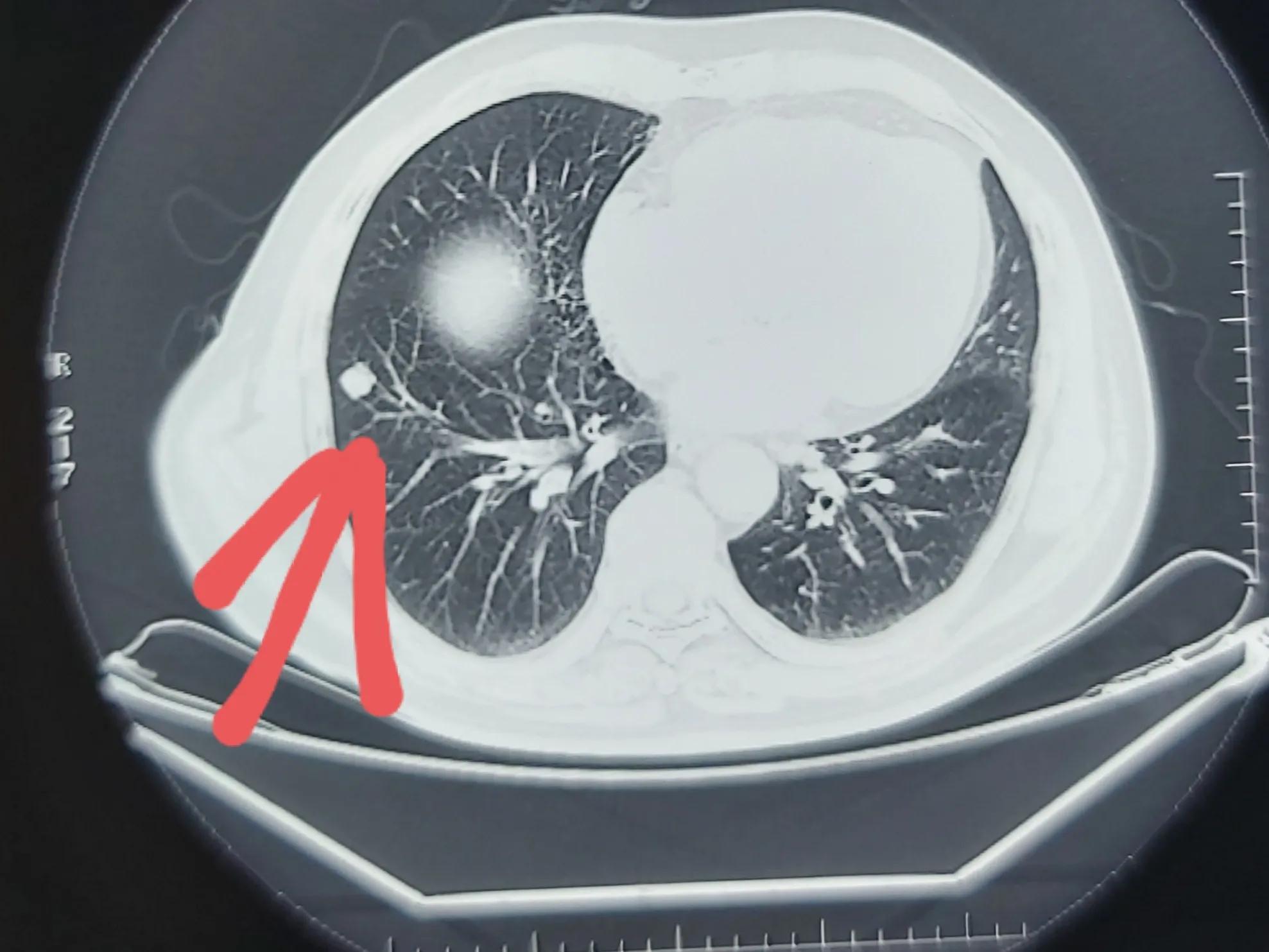 七种自身抗体检测肺癌正常指标,刘懿博士说肺癌免疫治疗