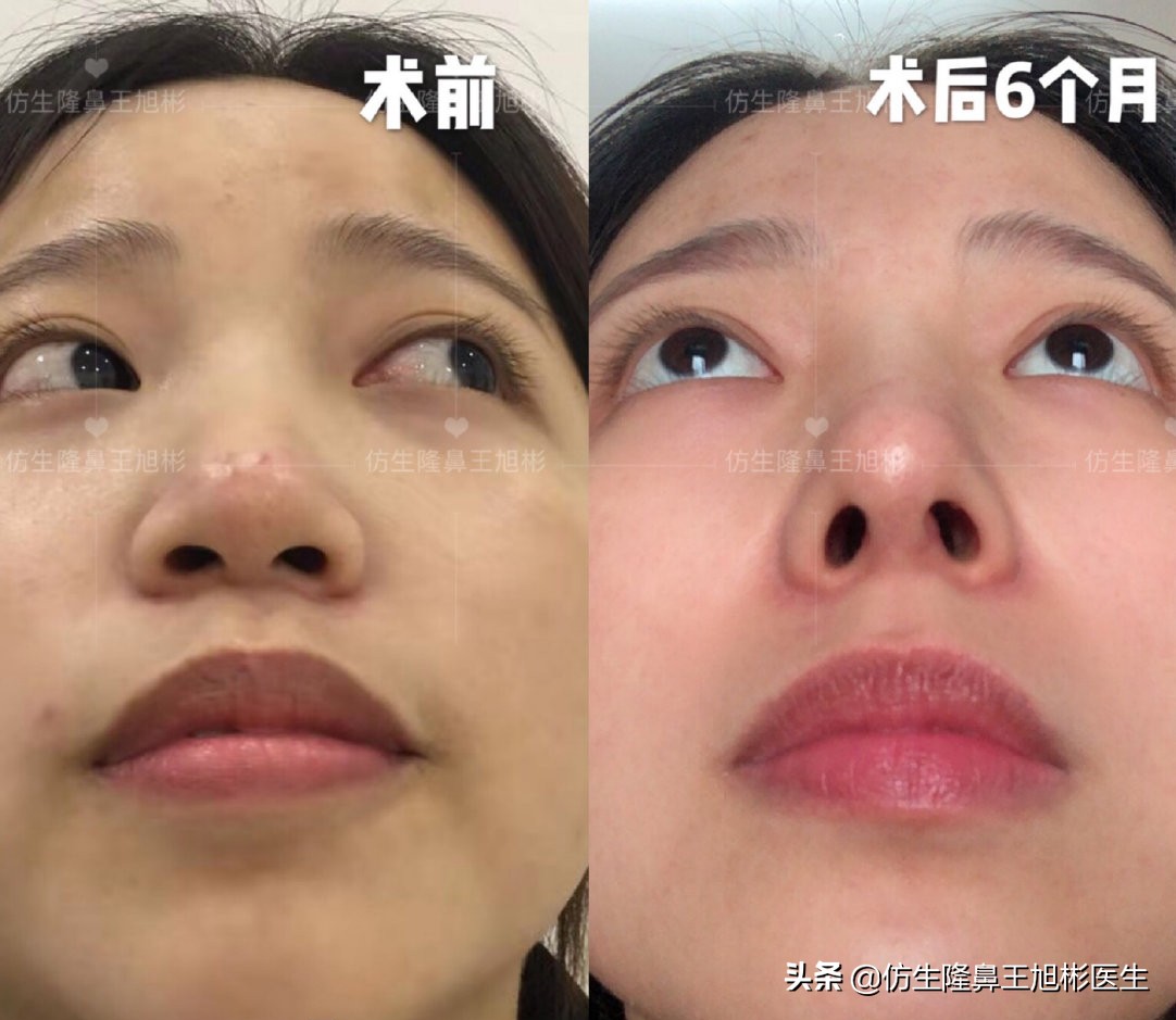 鼻头和鼻小柱是如何抬高的,鼻头扁是什么预兆
