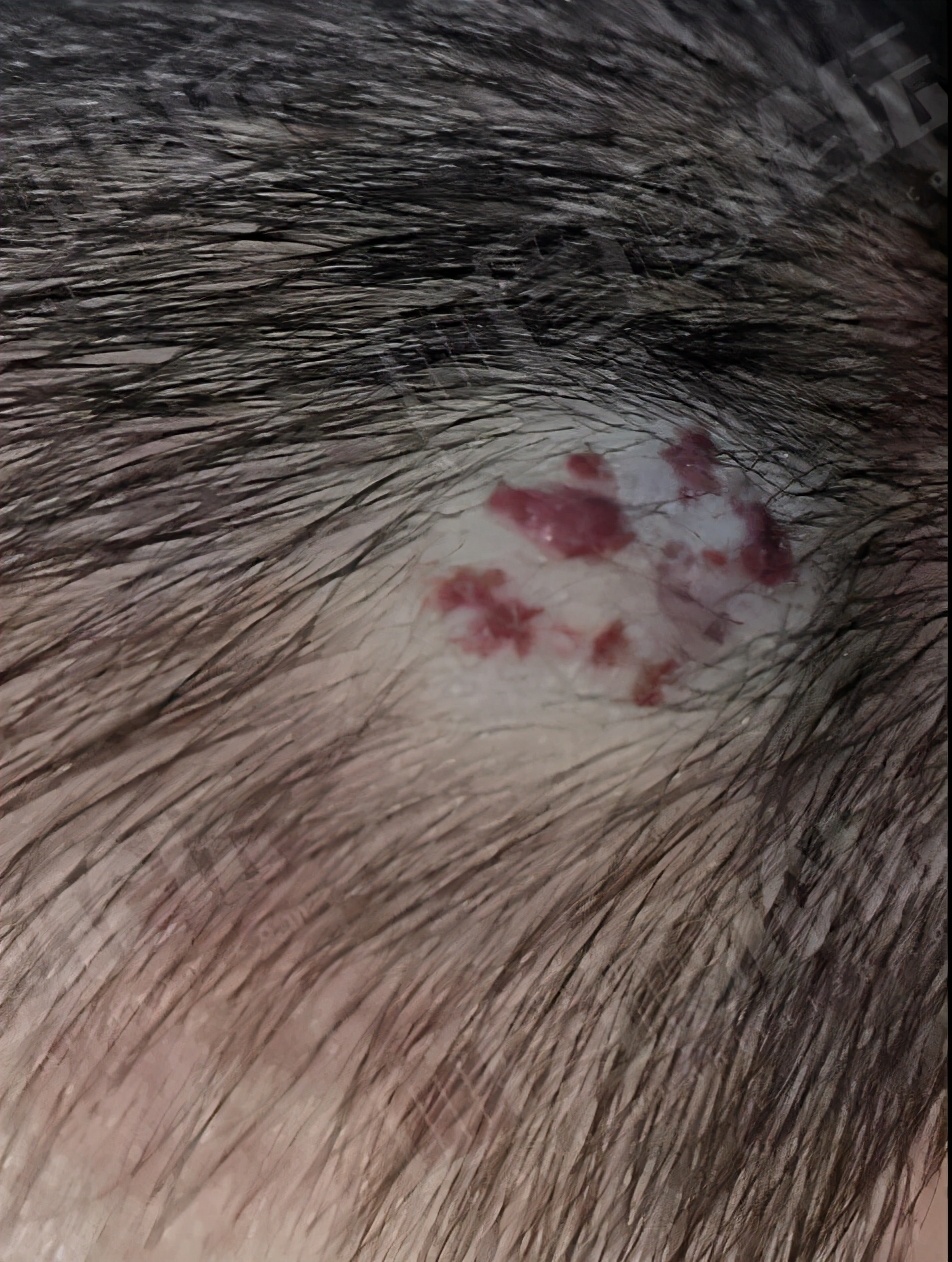 婴幼儿血管瘤的治疗「009期」董欣竞医生科普